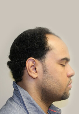 hair transplant photos