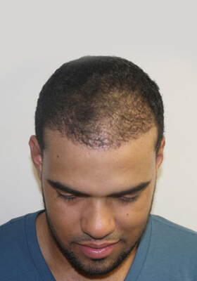 hair transplant photos