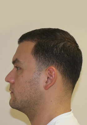 hair transplant photos