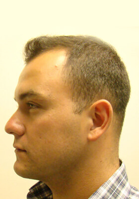 hair transplant photos