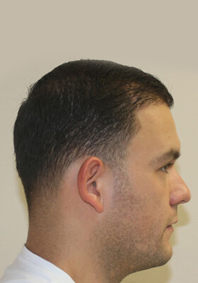 hair transplant photos