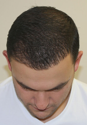 hair transplant photos