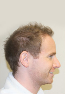 hair transplant photos