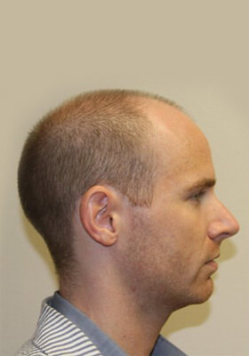 hair transplant photos