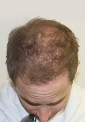 hair transplant photos