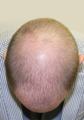 hair transplant photos