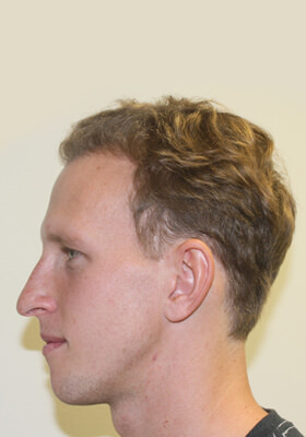 hair transplant photos