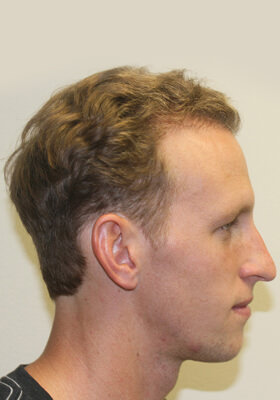 hair transplant photos