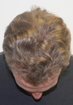 hair transplant before after Photos