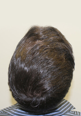 hair transplant photos