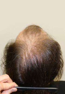 hair transplant photos