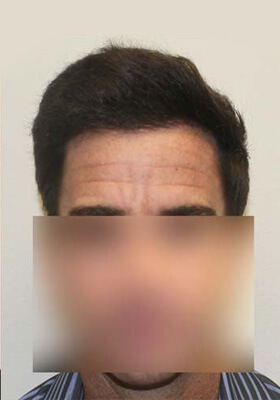 hair transplant photos