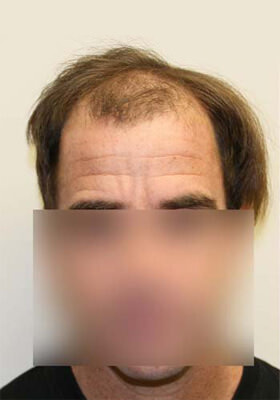 hair transplant photos