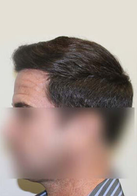 hair transplant photos