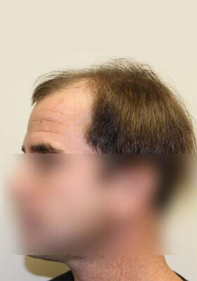 hair transplant photos