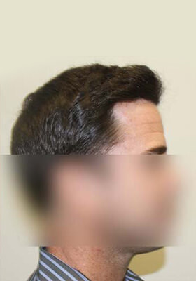 hair transplant photos