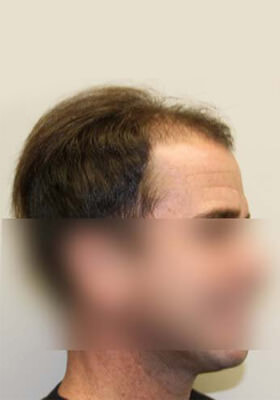 hair transplant photos