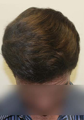 hair transplant photos