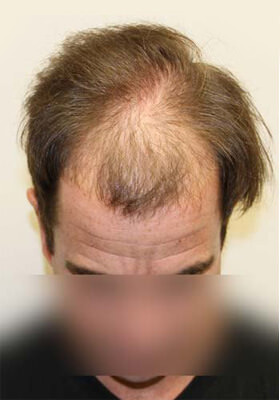 hair transplant photos