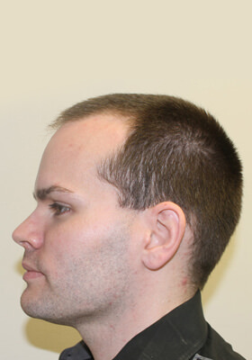 hair transplant photos