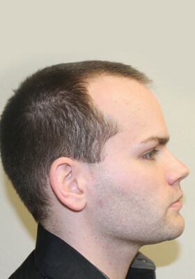 hair transplant photos