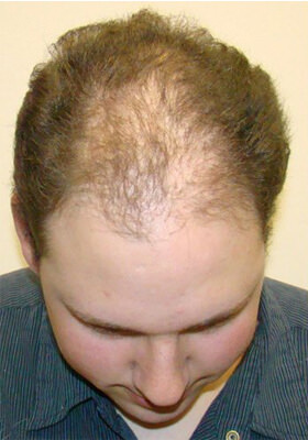 hair transplant before after Photos