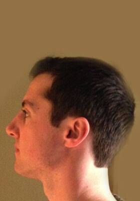 hair transplant photos