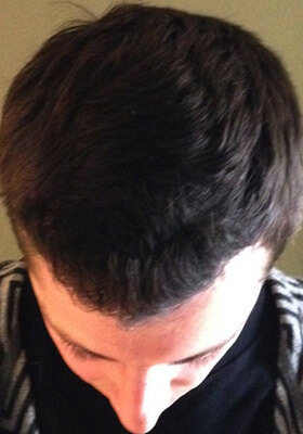 hair transplant before after Photos