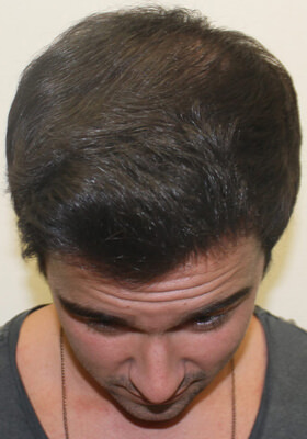 hair transplant photos