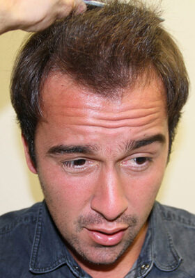 hair transplant photos