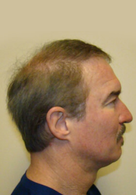 hair transplant photos