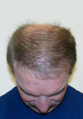 hair transplant before after Photos