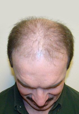 hair transplant before after Photos