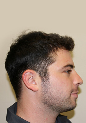 hair transplant photos