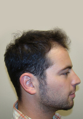 hair transplant photos