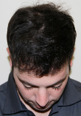 hair transplant before after Photos