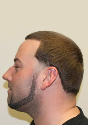 hair transplant photos