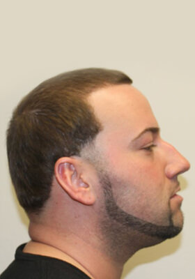 hair transplant photos