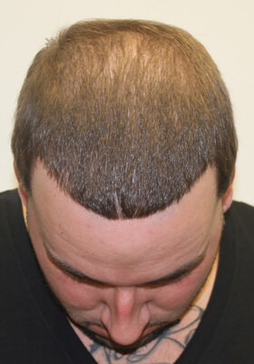 hair transplant before after Photos