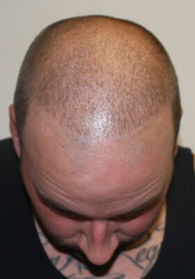 hair transplant photos