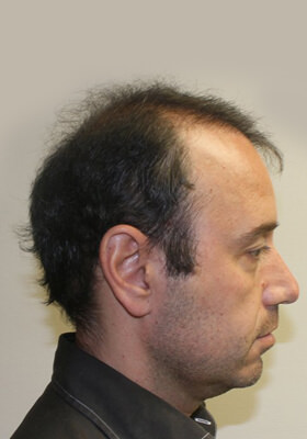 hair transplant photos