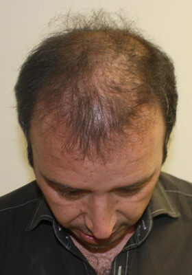 hair transplant before after Photos