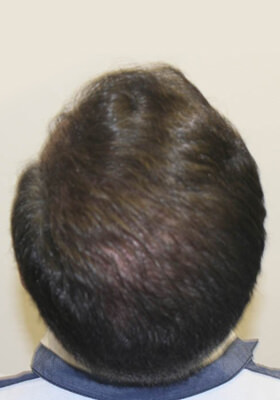 hair transplant photos