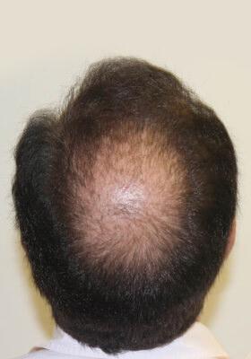 hair transplant photos