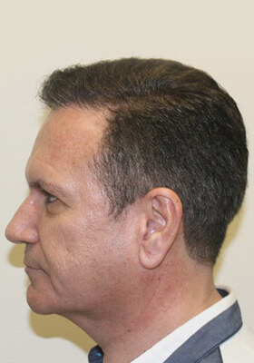 hair transplant photos