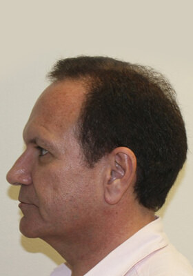 hair transplant photos