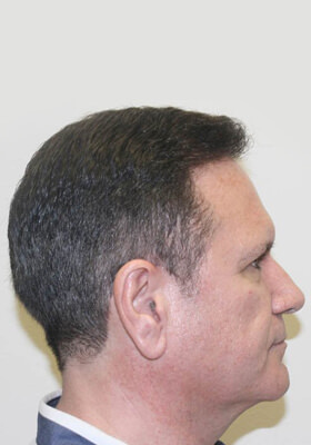 hair transplant photos