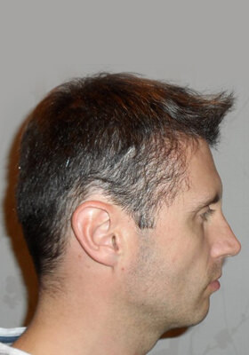 hair transplant photos