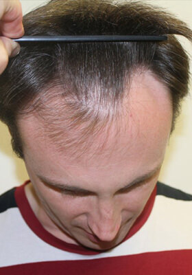 hair transplant before after Photos