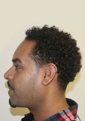 hair transplant photos